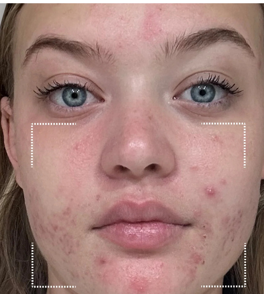 Limpieza Stop Acne (Purifyng) + Evaluación y asesoría